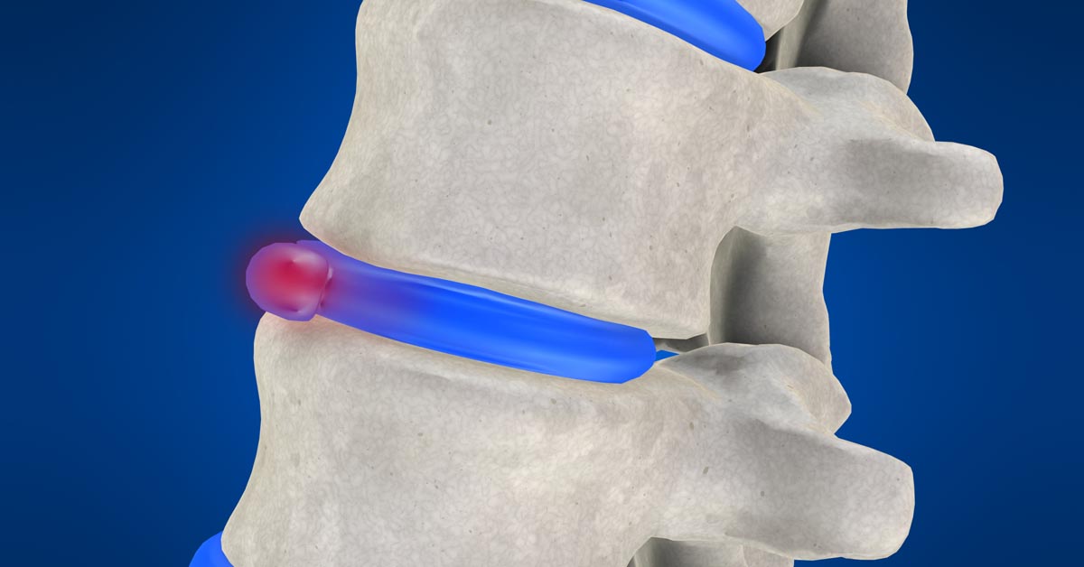 Great Falls, MT non-surgical disc herniation treatment